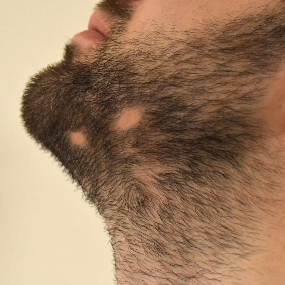 alopecia areata na barba