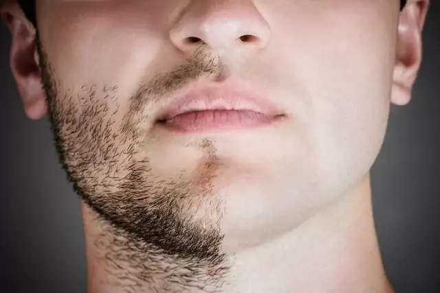 resultados minoxidil para barba